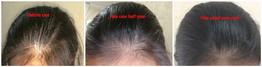 kirkland minoxidil